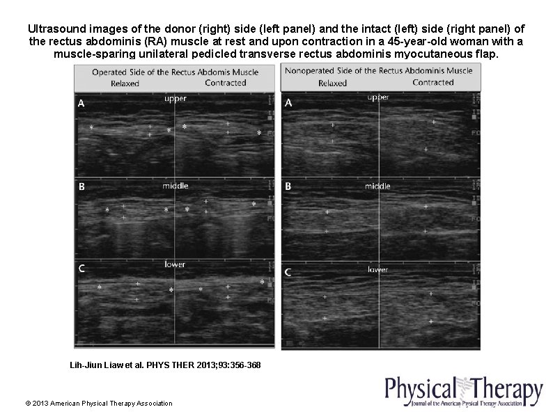 Ultrasound images of the donor (right) side (left panel) and the intact (left) side