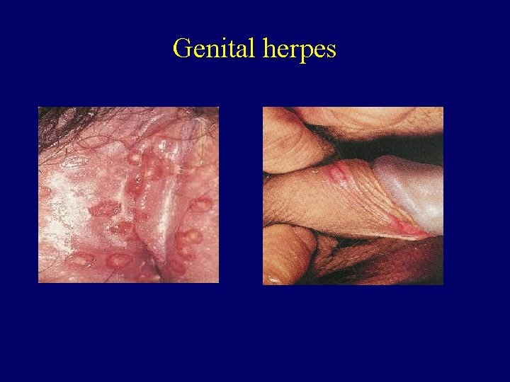 Genital herpes 