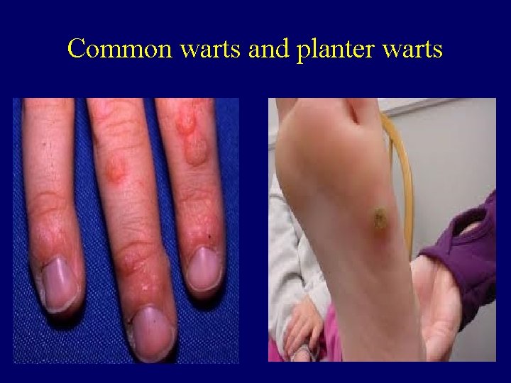 Common warts and planter warts 