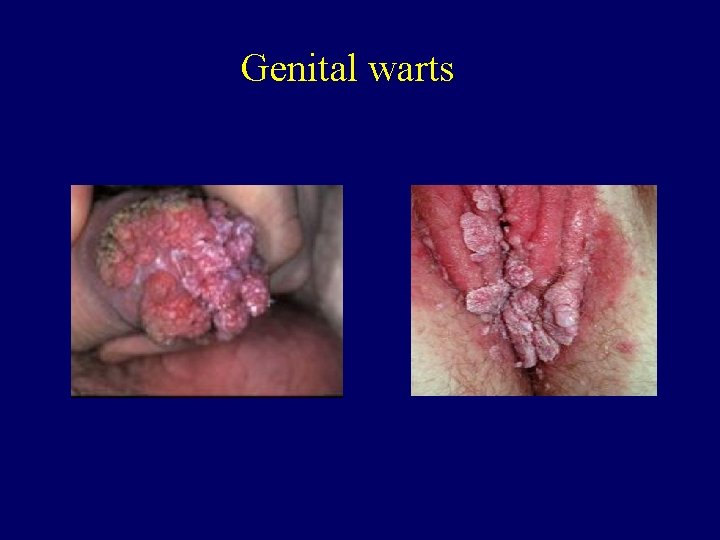 Genital warts 