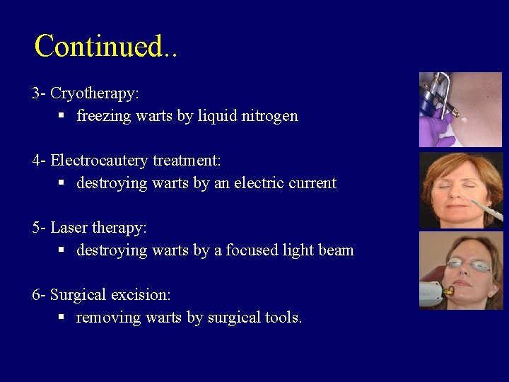 Continued. . 3 - Cryotherapy: § freezing warts by liquid nitrogen 4 - Electrocautery