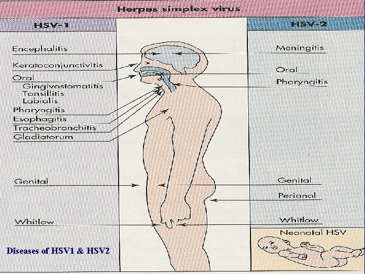 Diseases of HSV 1 & HSV 2 