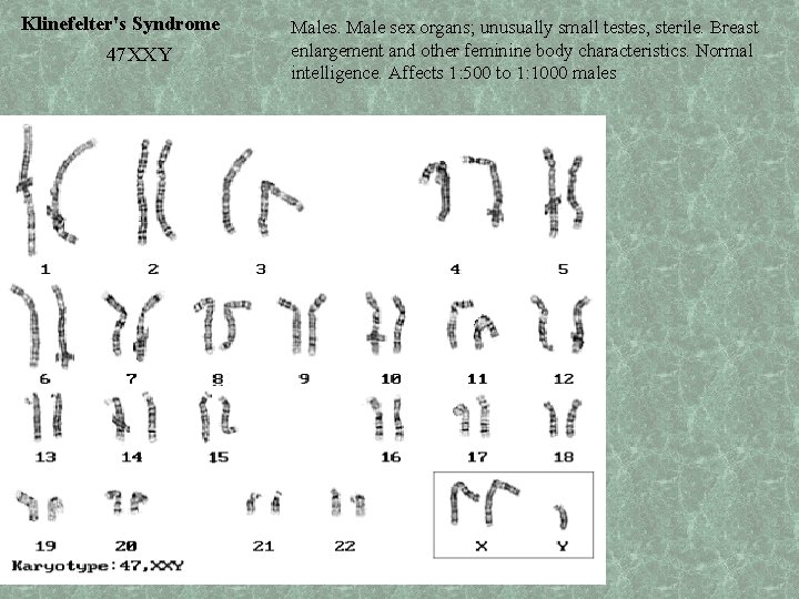 Klinefelter's Syndrome 47 XXY Males. Male sex organs; unusually small testes, sterile. Breast enlargement