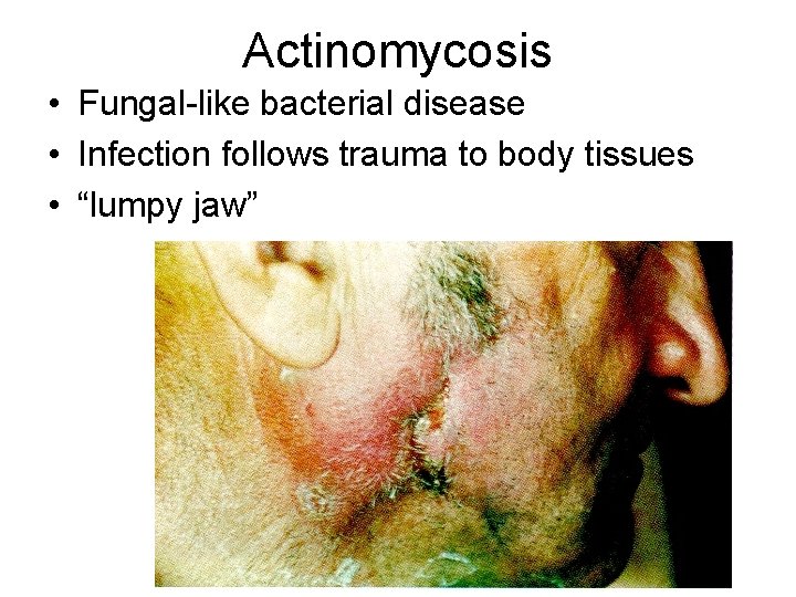 Actinomycosis • Fungal-like bacterial disease • Infection follows trauma to body tissues • “lumpy
