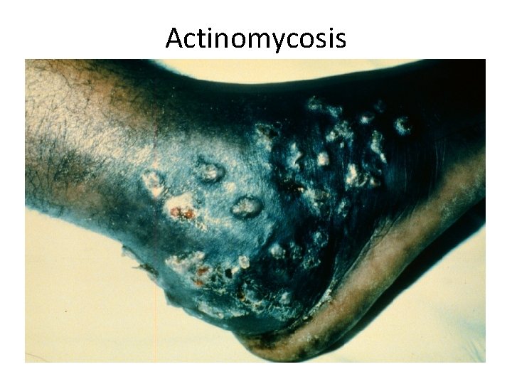 Actinomycosis 