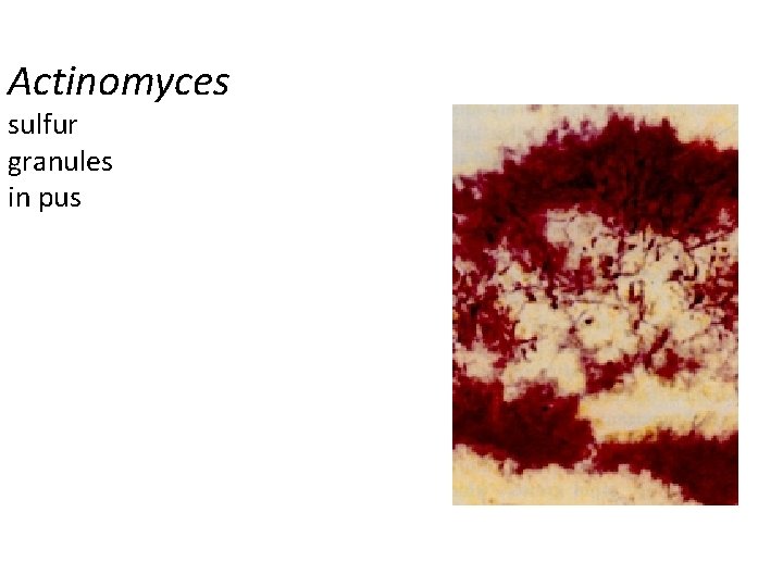 Actinomyces sulfur granules in pus 