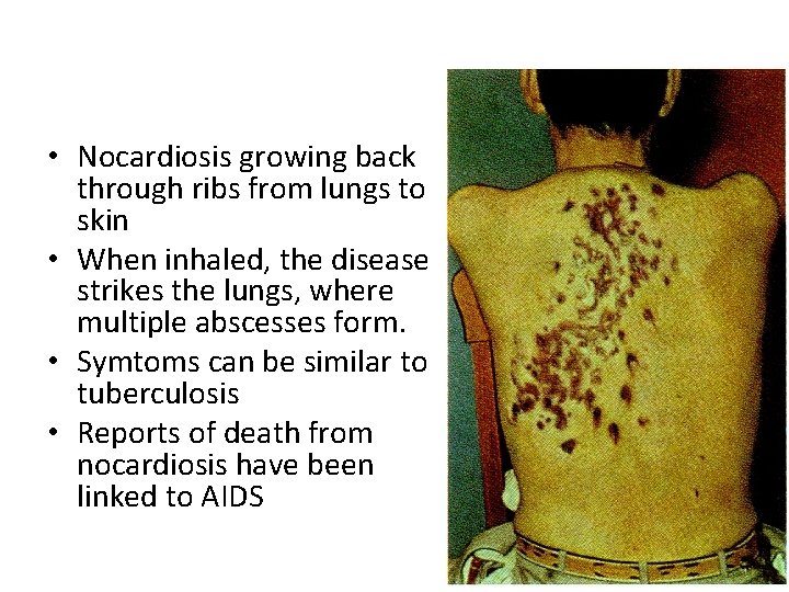  • Nocardiosis growing back through ribs from lungs to skin • When inhaled,