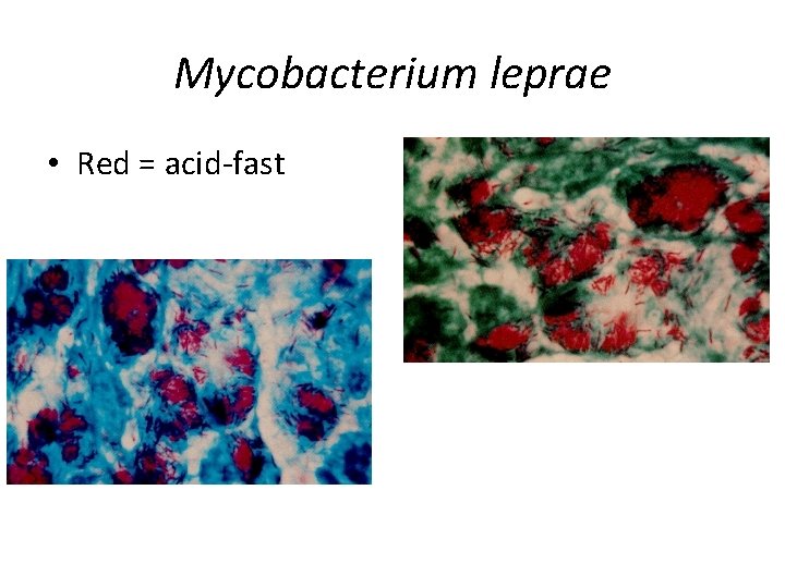 Mycobacterium leprae • Red = acid-fast 