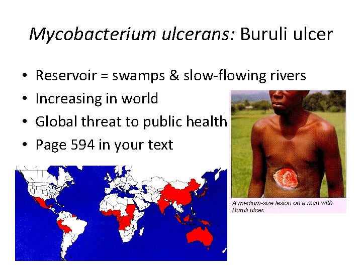 Mycobacterium ulcerans: Buruli ulcer • • Reservoir = swamps & slow-flowing rivers Increasing in