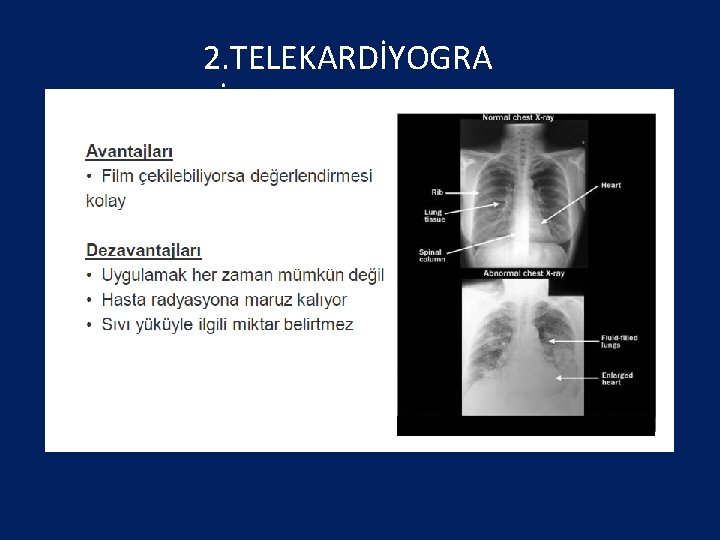 2. TELEKARDİYOGRA Fİ 