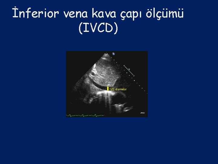 İnferior vena kava çapı ölçümü (IVCD) 