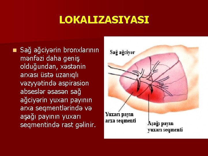 LOKALIZASIYASI n Sağ ağciyərin bronxlarının mənfəzi daha geniş olduğundan, xəstənin arxası üstə uzanıqlı vəzyyətində