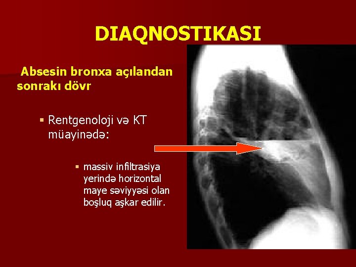 DIAQNOSTIKASI Absesin bronxa açılandan sonrakı dövr § Rentgenoloji və KT müayinədə: § massiv infiltrasiya