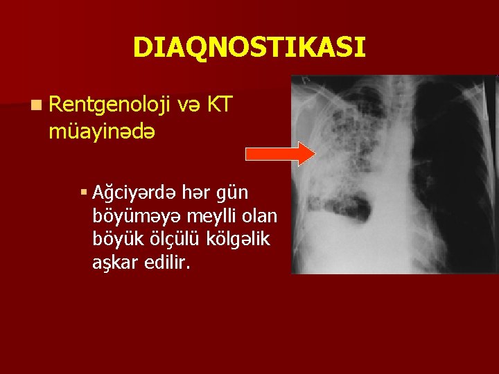 DIAQNOSTIKASI n Rentgenoloji müayinədə və KT § Ağciyərdə hər gün böyüməyə meylli olan böyük