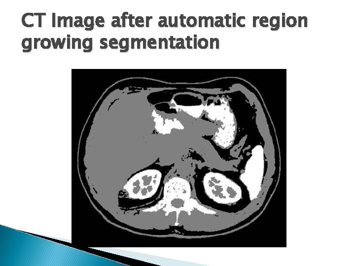 CT Image after automatic region growing segmentation CT Image after automatic region growing segmentation