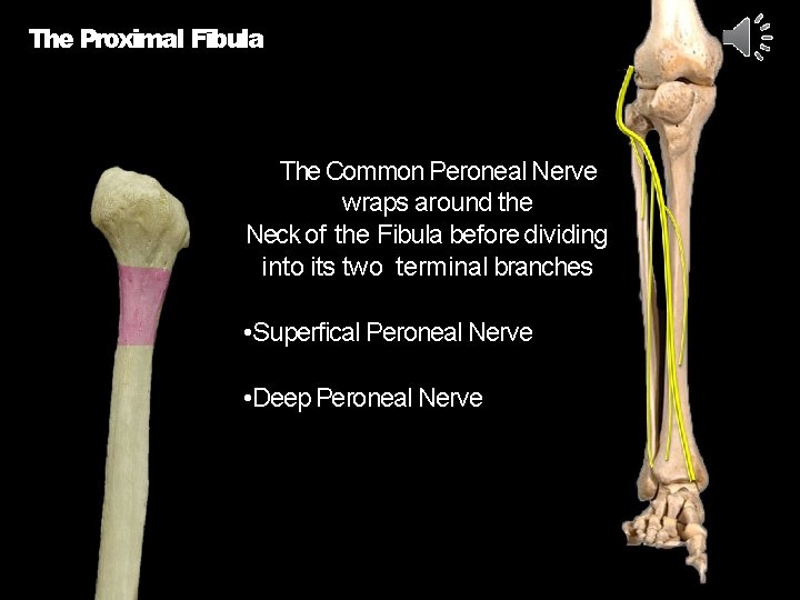 The Proximal Fibula The Common Peroneal Nerve wraps around the Neck of the Fibula