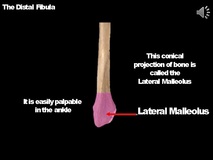 The Distal Fibula This conical projection of bone is called the Lateral Malleolus It