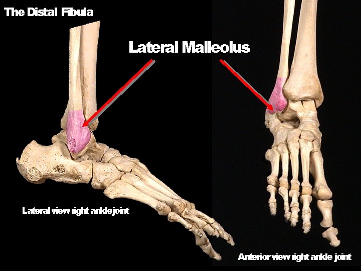 The Distal Fibula Lateral Malleolus Lateral view right anklejoint Anterior view right ankle joint