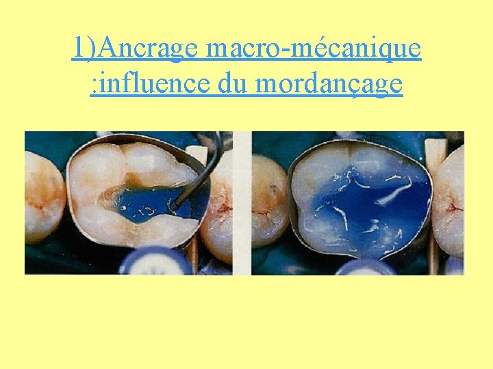 1)Ancrage macro-mécanique : influence du mordançage 