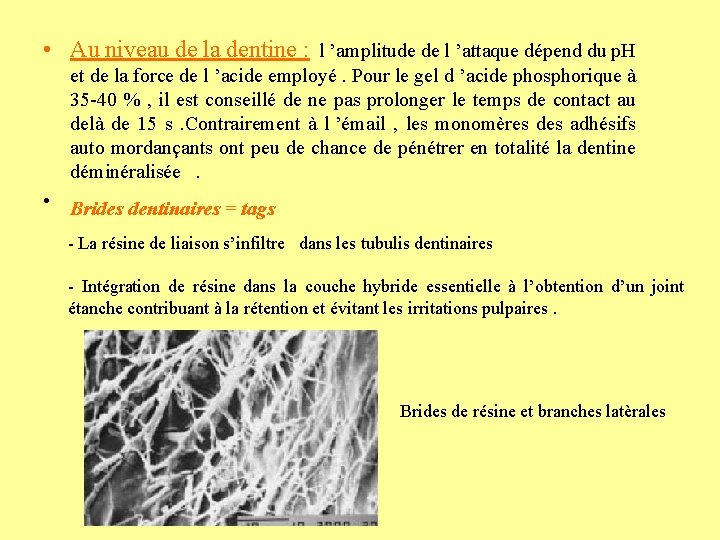  • Au niveau de la dentine : l ’amplitude de l ’attaque dépend