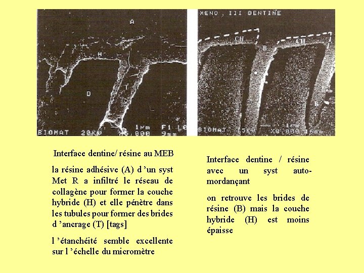 Interface dentine/ résine au MEB la résine adhésive (A) d ’un syst Met R