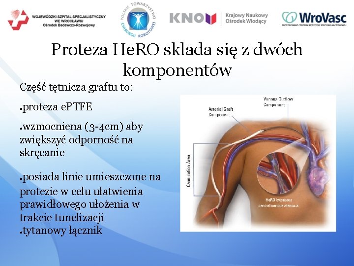 Proteza He. RO składa się z dwóch komponentów Część tętnicza graftu to: proteza e.