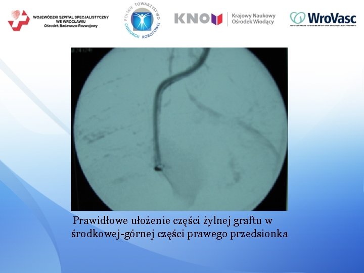 Prawidłowe ułożenie części żylnej graftu w środkowej-górnej części prawego przedsionka 