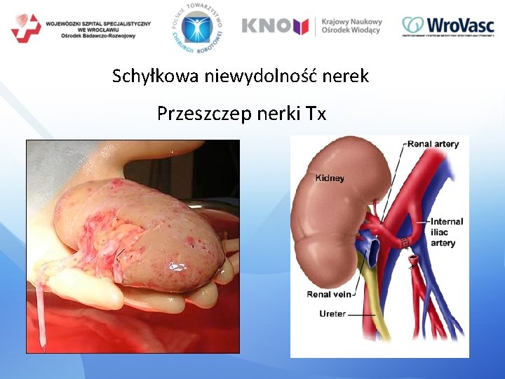 Schyłkowa niewydolność nerek Przeszczep nerki Tx 