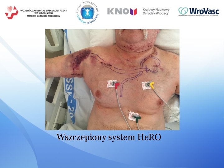 Wszczepiony system He. RO 