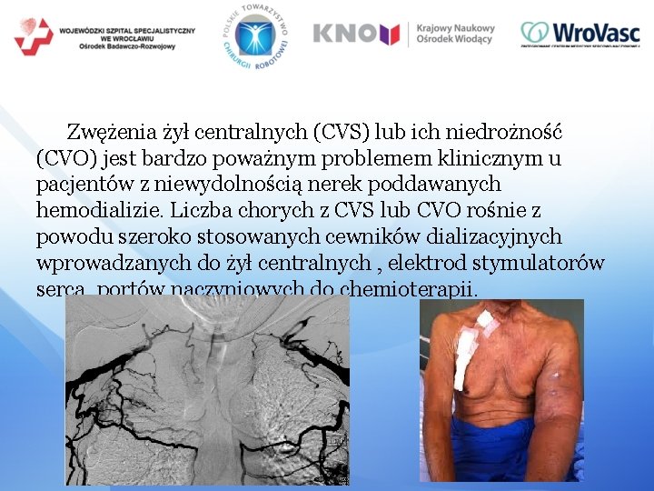 Zwężenia żył centralnych (CVS) lub ich niedrożność (CVO) jest bardzo poważnym problemem klinicznym u