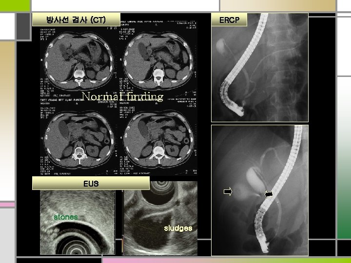 ERCP 방사선 검사 (CT) Normal finding EUS stones sludges 