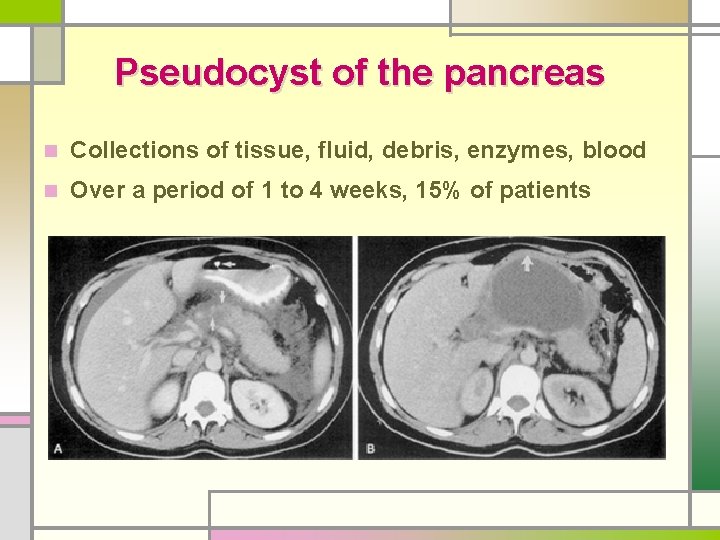 Pseudocyst of the pancreas n Collections of tissue, fluid, debris, enzymes, blood n Over