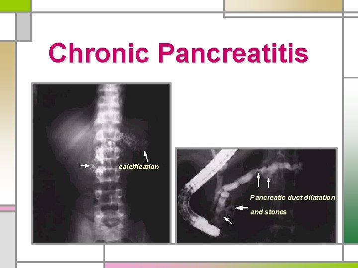 Chronic Pancreatitis calcification Pancreatic duct dilatation and stones 