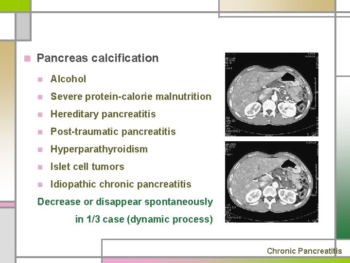 n Pancreas calcification n Alcohol n Severe protein-calorie malnutrition n Hereditary pancreatitis n Post-traumatic