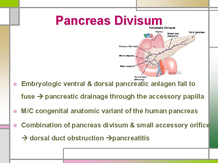 Pancreas Divisum n Embryologic ventral & dorsal pancreatic anlagen fail to fuse pancreatic drainage