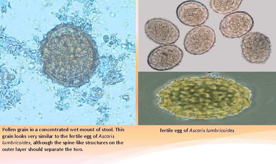 Pollen grain in a concentrated wet mount of stool. This grain looks very similar