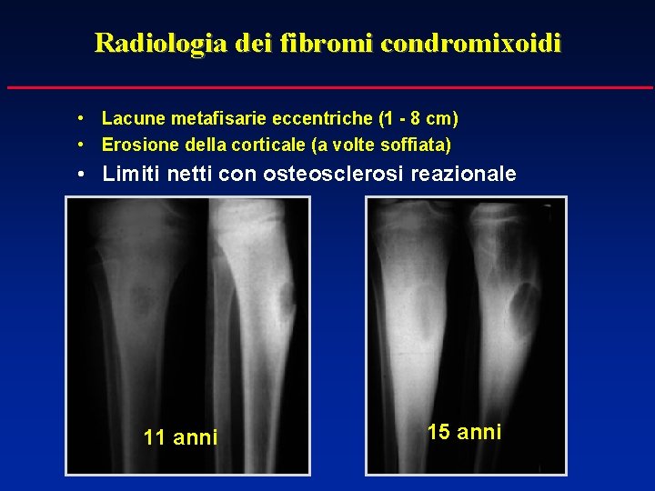 Radiologia dei fibromi condromixoidi • Lacune metafisarie eccentriche (1 - 8 cm) • Erosione