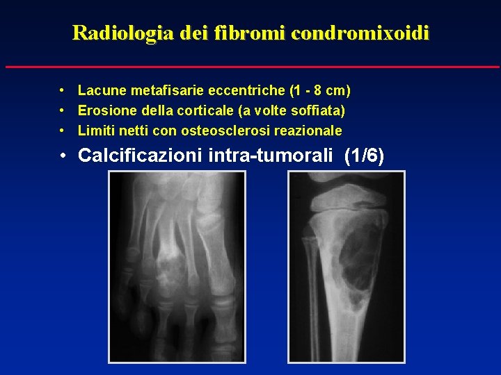 Radiologia dei fibromi condromixoidi • Lacune metafisarie eccentriche (1 - 8 cm) • Erosione