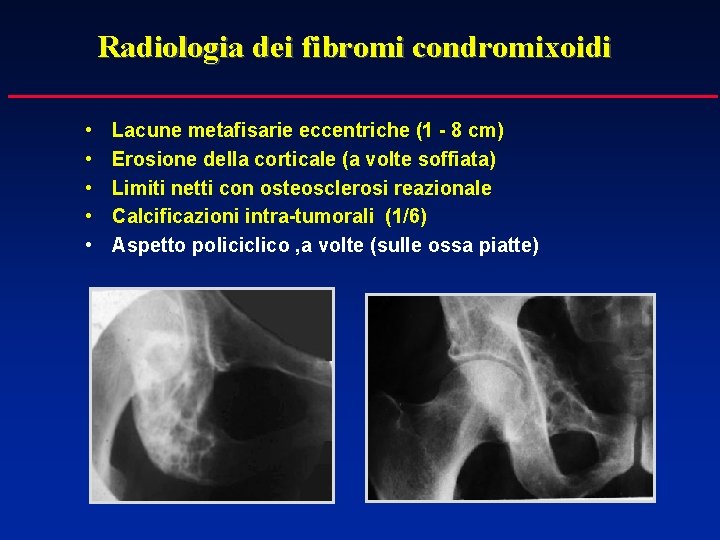 Radiologia dei fibromi condromixoidi • • • Lacune metafisarie eccentriche (1 - 8 cm)