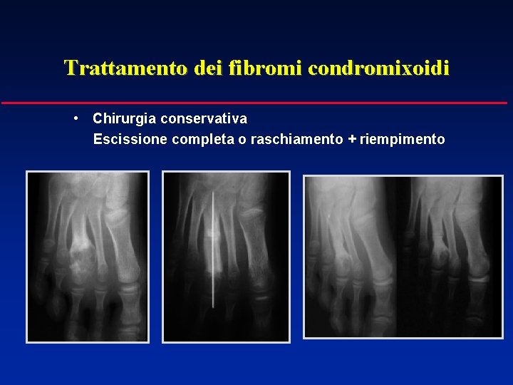 Trattamento dei fibromi condromixoidi • Chirurgia conservativa Escissione completa o raschiamento + riempimento 