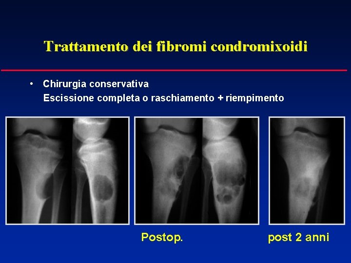 Trattamento dei fibromi condromixoidi • Chirurgia conservativa Escissione completa o raschiamento + riempimento Postop.