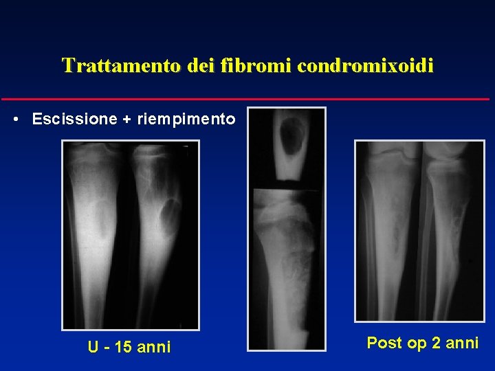 Trattamento dei fibromi condromixoidi • Escissione + riempimento U - 15 anni Post op