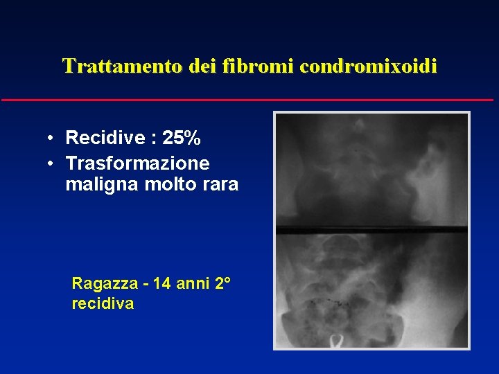 Trattamento dei fibromi condromixoidi • Recidive : 25% • Trasformazione maligna molto rara Ragazza