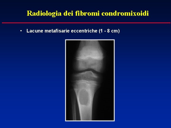 Radiologia dei fibromi condromixoidi • Lacune metafisarie eccentriche (1 - 8 cm) 