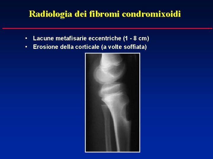 Radiologia dei fibromi condromixoidi • Lacune metafisarie eccentriche (1 - 8 cm) • Erosione