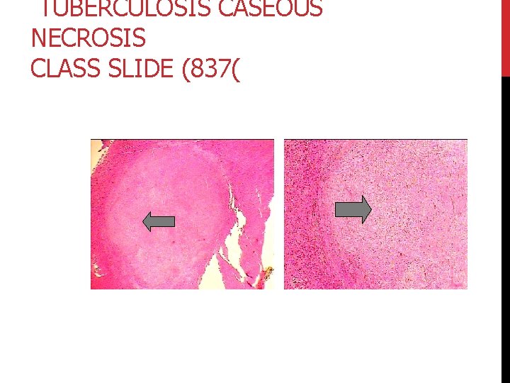 TUBERCULOSIS CASEOUS NECROSIS CLASS SLIDE (837( 