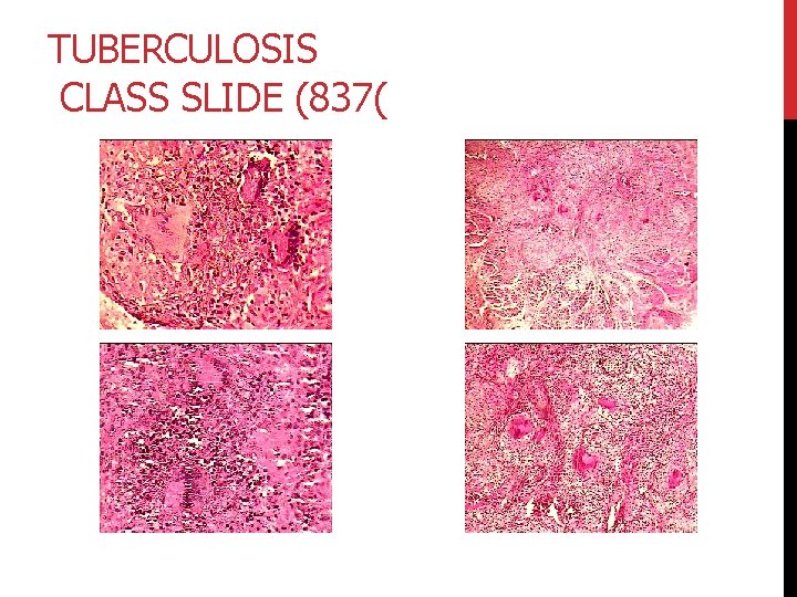 TUBERCULOSIS CLASS SLIDE (837( 