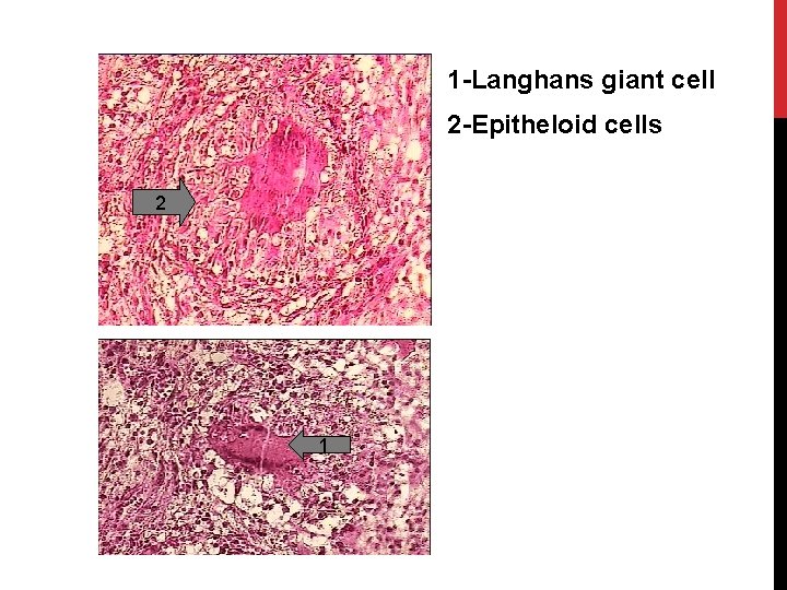 1 -Langhans giant cell 2 -Epitheloid cells 2 1 