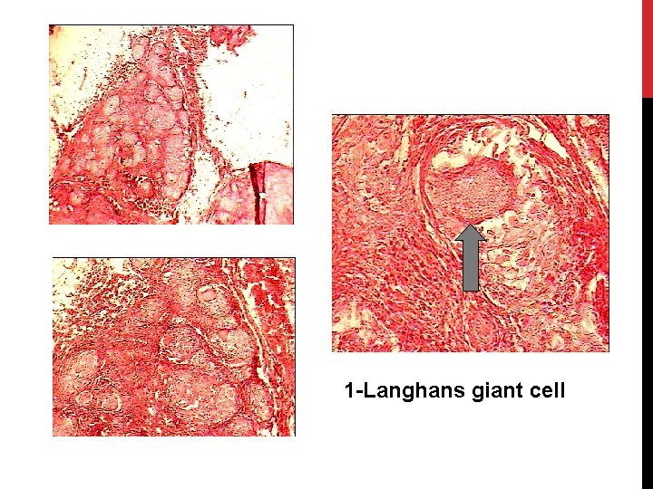 1 -Langhans giant cell 