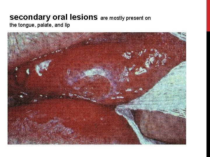 secondary oral lesions are mostly present on the tongue, palate, and lip 